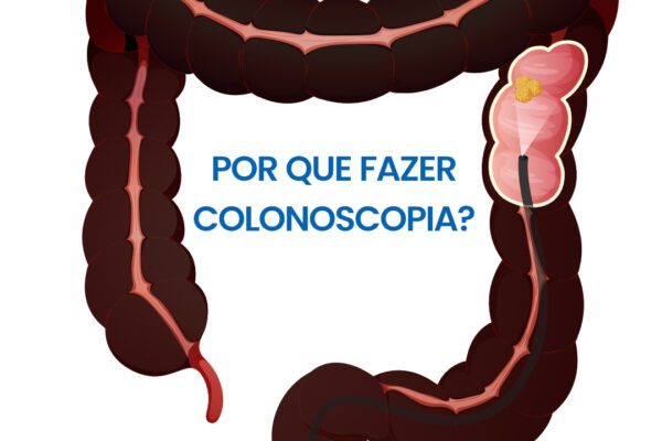 Por que fazer colonoscopia?